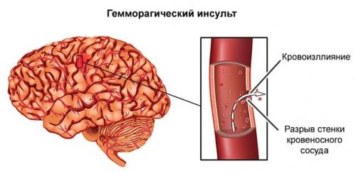 5 простых способов укрепить сосуды. Какие продукты нужно употреблять для укрепления стенок сосудов 02 5 простых способов укрепить сосуды. Какие продукты нужно употреблять для укрепления стенок сосудов 02