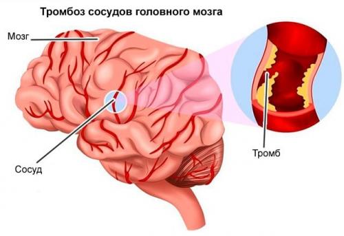 5 простых способов укрепить сосуды. Какие продукты нужно употреблять для укрепления стенок сосудов 01 5 простых способов укрепить сосуды. Какие продукты нужно употреблять для укрепления стенок сосудов 01