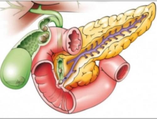Какие основные признаки панкреатита нужно знать обязательно. Причины панкреатита 04