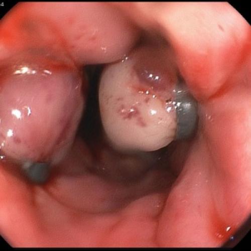 Современные возможности терапии хронического панкреатита. Guidelines of the Russian gastroenterological association on diagnostics and treatment of a chronic pancreatitis 04
