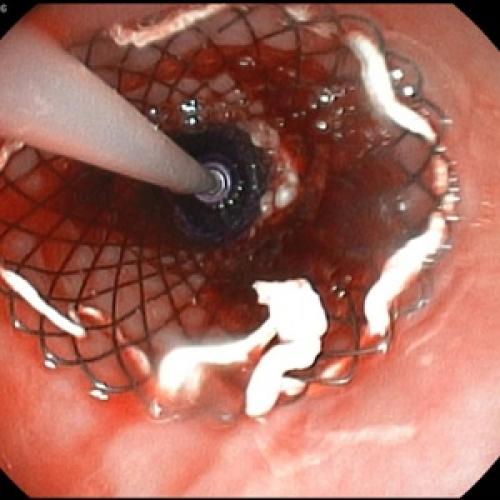 Современные возможности терапии хронического панкреатита. Guidelines of the Russian gastroenterological association on diagnostics and treatment of a chronic pancreatitis 03