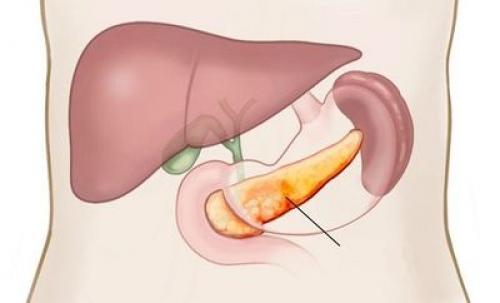 Питание при панкреатите поджелудочной железы. Питание в острой стадии панкреатита 07
