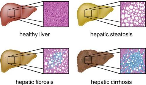 Функции печени в нормализации избыточного веса. Определение болезни. Причины заболевания 01 Функции печени в нормализации избыточного веса. Определение болезни. Причины заболевания 01