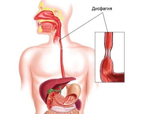 Диета при гастроэзофагеальной рефлюксной болезни. Рекомендации при ГЭРБ 02