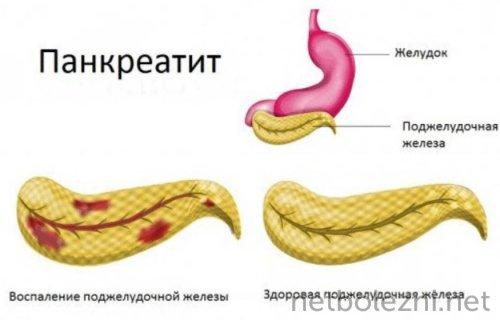 Опасный для жизни приступ панкреатита. Симптомы панкреатита 02