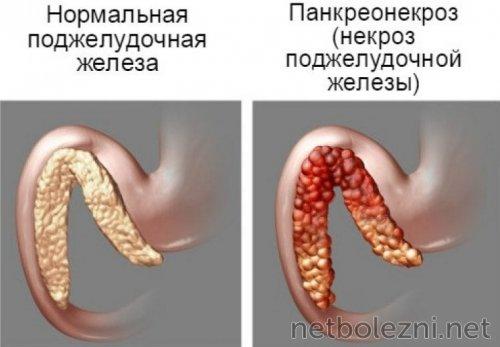Как и чем снять приступ острого панкреатита. Какие факторы вызывают приступ острого панкреатита? 02