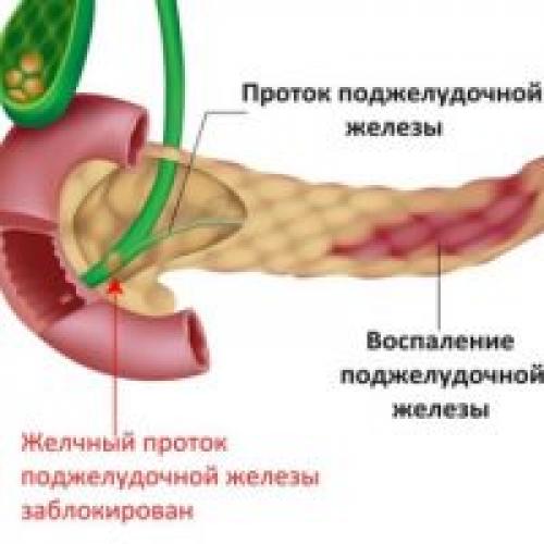 Как жить с хроническим панкреатитом. Хронический панкреатит. Причины развития