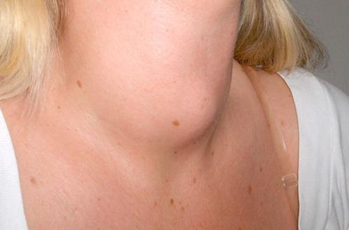 Воспаление щитовидной железы симптомы. Какие бывают виды тиреоидитов?