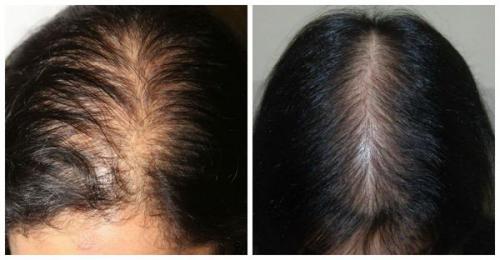 Сильно выпадают волосы у женщины. Лечение и профилактика выпадения волос у девушек 08 Сильно выпадают волосы у женщины. Лечение и профилактика выпадения волос у девушек 08