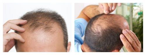 Сильно выпадают волосы у женщины. Лечение и профилактика выпадения волос у девушек 07 Сильно выпадают волосы у женщины. Лечение и профилактика выпадения волос у девушек 07