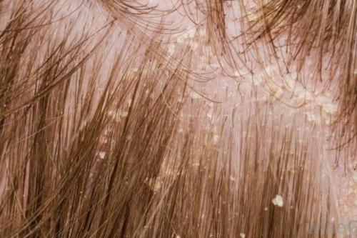 Сильно выпадают волосы у женщины. Лечение и профилактика выпадения волос у девушек 06