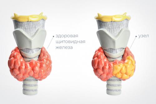 Рассасываются ли узлы на щитовидке. Причины появления