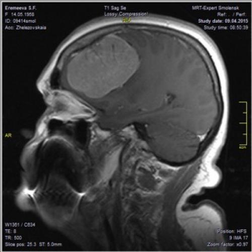 Диета при аутоиммунном тиреоидите щитовидной железы. Определение болезни. Причины заболевания 02
