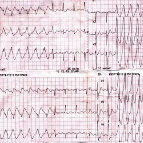 Диета при аутоиммунном тиреоидите щитовидной железы. Определение болезни. Причины заболевания 04