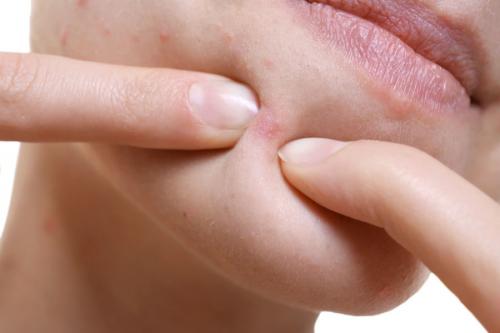 Как избежать проблем с кожей, которые могут быть связаны с ожирением в период менопаузы. Почему в период менопаузы возникает угревая сыпь