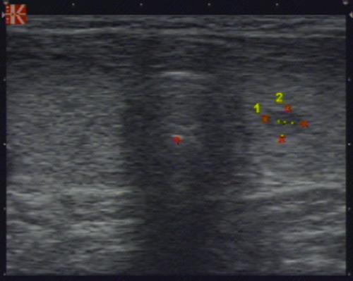 Протокол УЗИ щитовидной железы. Эхографические признаки диффузного токсического зоба (дифференцировать с простой гиперплазией щитовидной железы) в сочетании с аденомой левой доли щитовидной железы. Протокол УЗИ