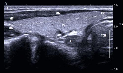 Неоднородная структура щитовидной железы. Объем щитовидной железы: размеры, необходимые для расчета