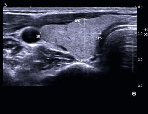 Неоднородная структура щитовидной железы. Объем щитовидной железы: размеры, необходимые для расчета