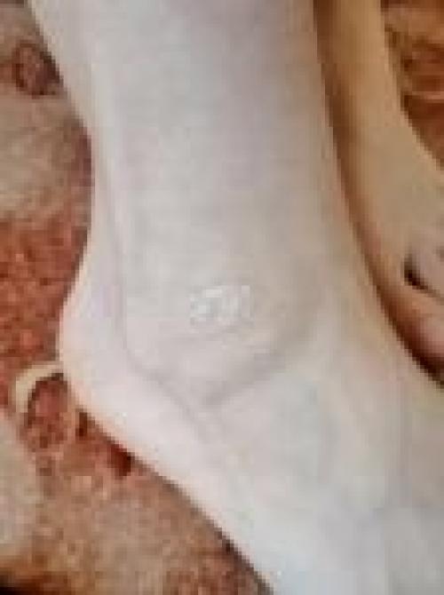 Здравствуйте.  Несколько месяцев назад на коленях локтях и щиколотке появились вот такое места. 01