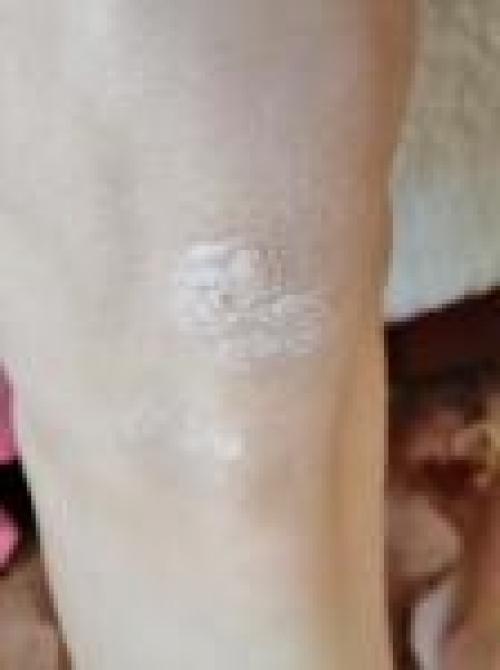 Здравствуйте.  Несколько месяцев назад на коленях локтях и щиколотке появились вот такое места. 02