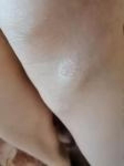 Здравствуйте.  Несколько месяцев назад на коленях локтях и щиколотке появились вот такое места.