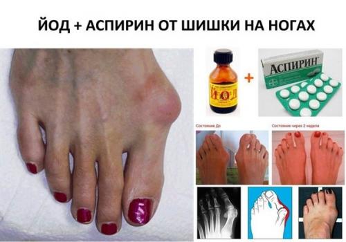 Как избавится от шишок на ногах.

